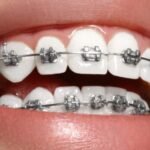 Metal-braces-What-are-dental-braces-1024x499-1