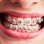 Shot of child's teeth with braces